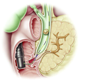 ERCP,gallbladder image,gallstone treatment in hyderabad