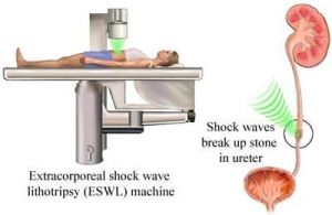 eswl machine,gallbladder treatment in hyderabad,gallstones treatment in india